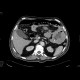 Lymphoma of small bowel: CT - Computed tomography